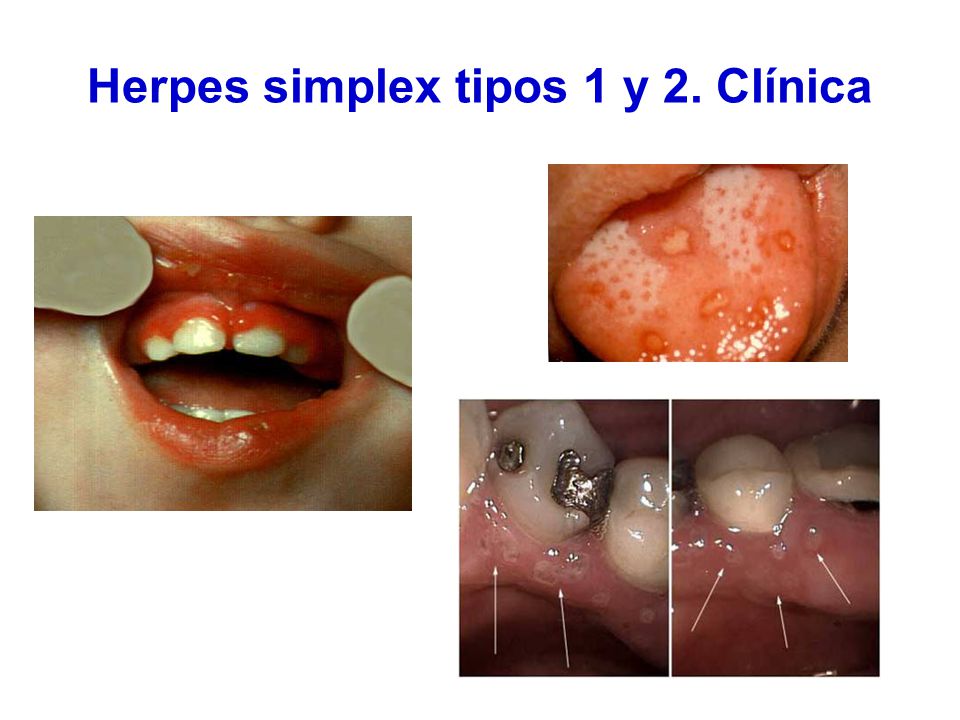 Herpes simplex tipos 1 y 2. Clínica