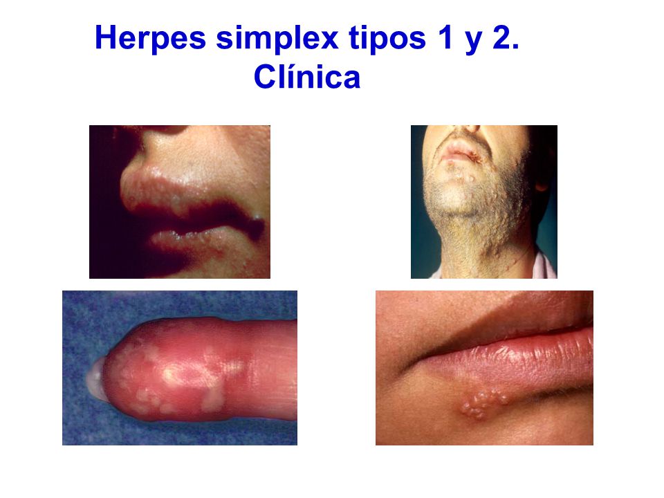 Herpes simplex tipos 1 y 2. Clínica