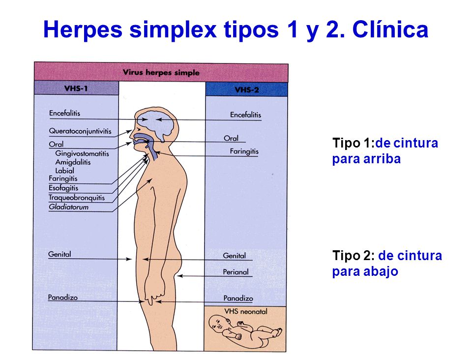 Herpes simplex tipos 1 y 2. Clínica