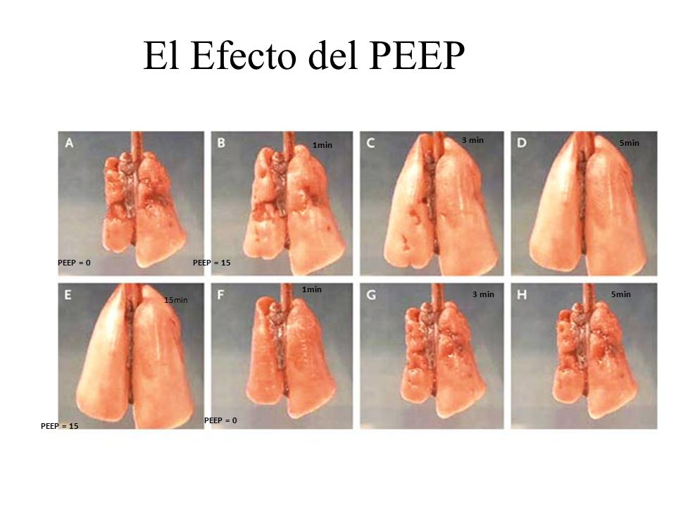 El Efecto del PEEP NEJM 2006;354: min 1min 5min PEEP = 0
