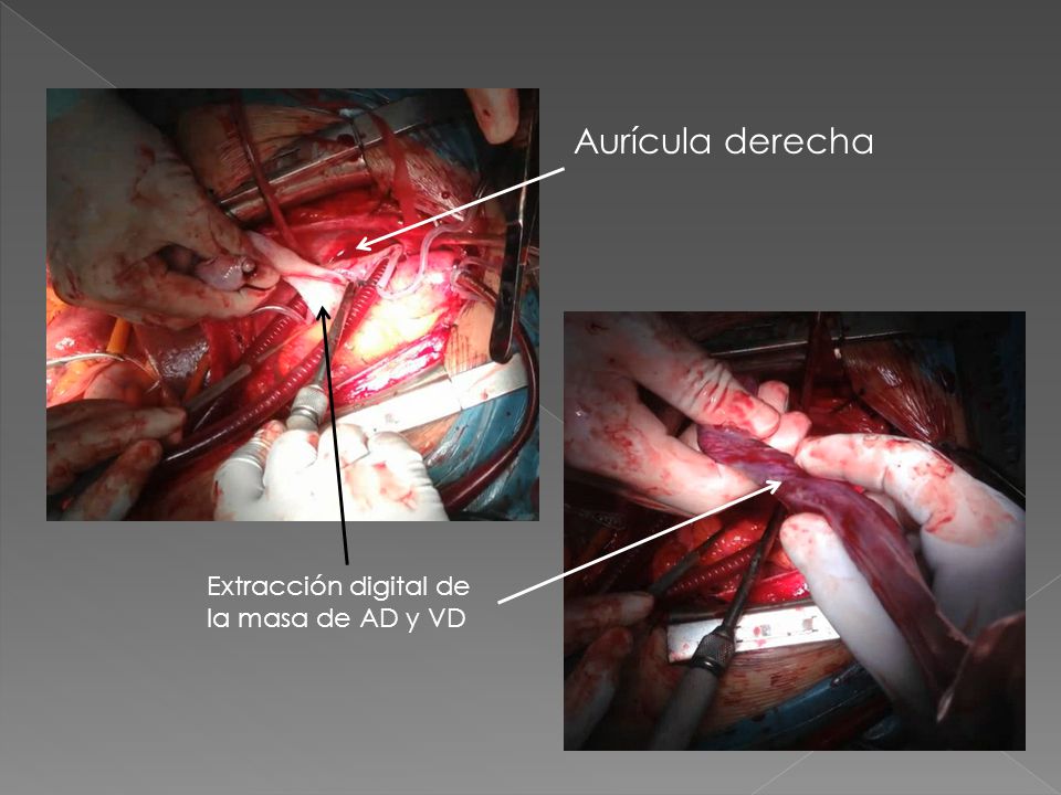 Aurícula derecha Extracción digital de la masa de AD y VD