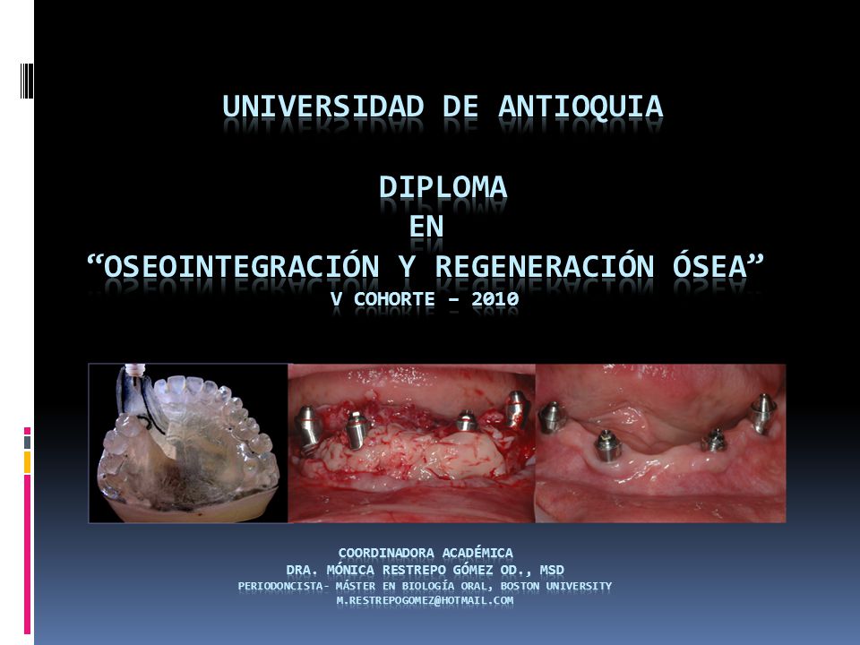 UNIVERSIDAD DE ANTIOQUIA DIPLOMA en OSEOINTEGRACIÓN Y REGENERACIÓN ÓSEA V COHORTE – 2010 Coordinadora Académica Dra.