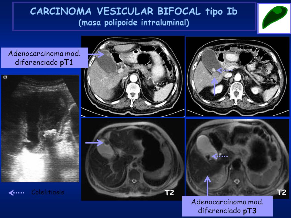 CARCINOMA VESICULAR BIFOCAL tipo Ib (masa polipoide intraluminal)
