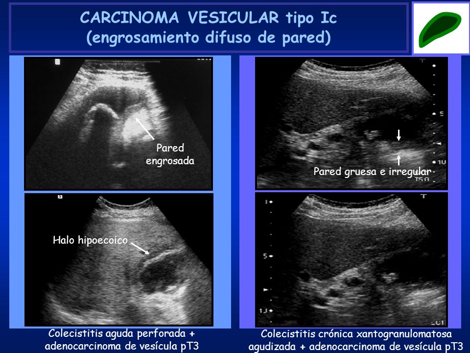 CARCINOMA VESICULAR tipo Ic (engrosamiento difuso de pared)