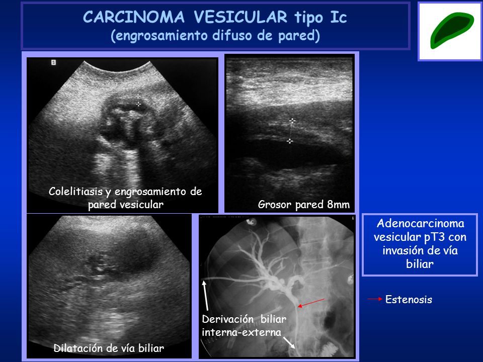 CARCINOMA VESICULAR tipo Ic (engrosamiento difuso de pared)