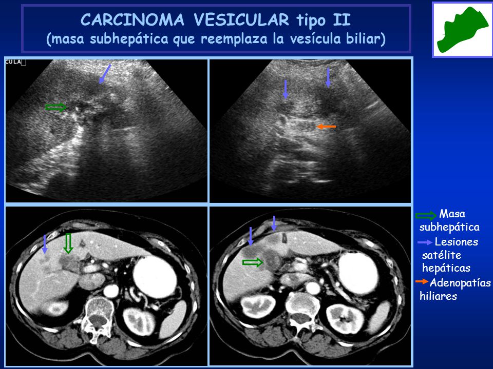 CARCINOMA VESICULAR tipo II (masa subhepática que reemplaza la vesícula biliar)