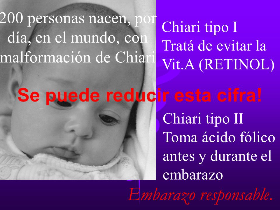 200 personas nacen, por día, en el mundo, con malformación de Chiari