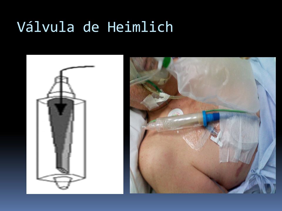 Válvula de Heimlich En 1968 se introdujo la válvula de Heimlich9. Esta válvula unidireccional consiste en un.