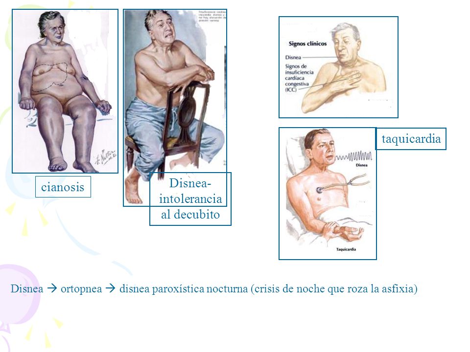 Disnea- intolerancia al decubito