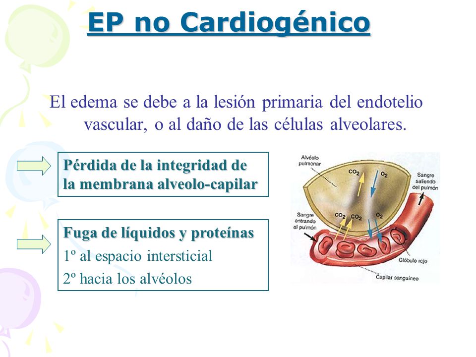 EP no Cardiogénico El edema se debe a la lesión primaria del endotelio vascular, o al daño de las células alveolares.