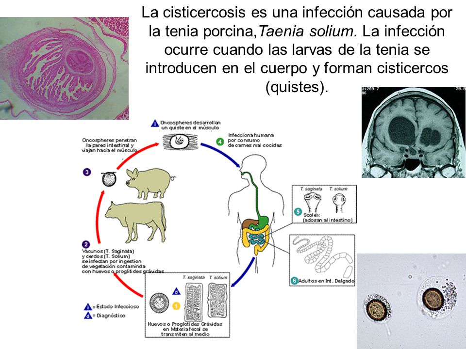 La cisticercosis es una infección causada por la tenia porcina,Taenia solium.