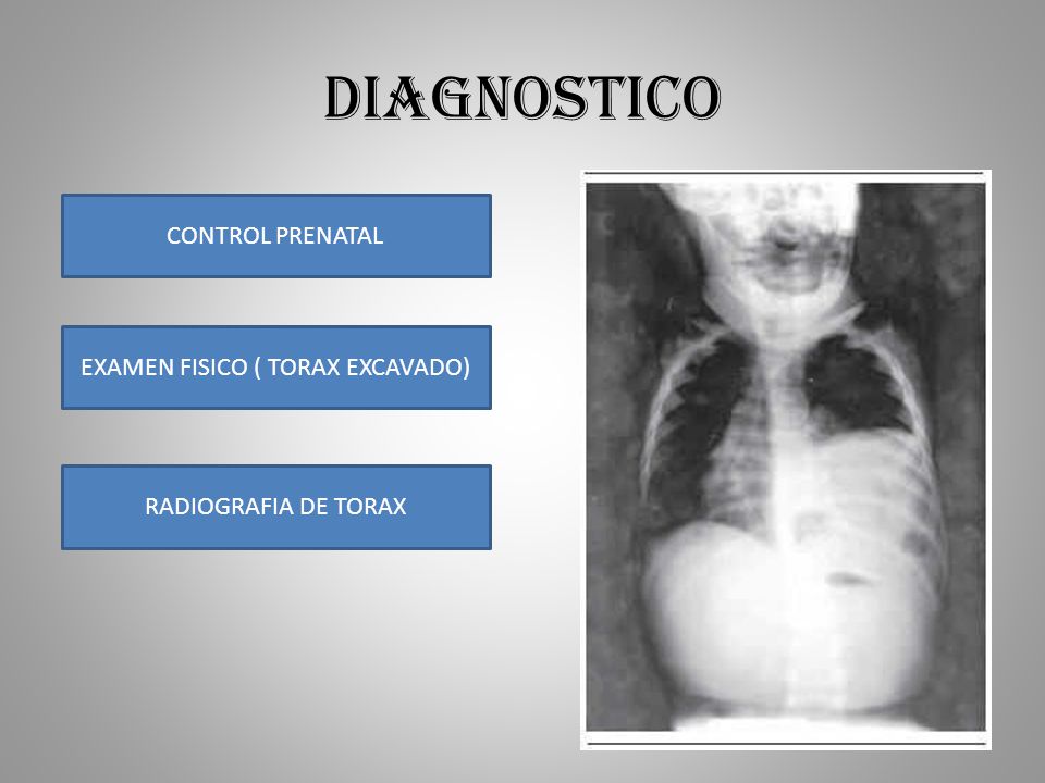 EXAMEN FISICO ( TORAX EXCAVADO)