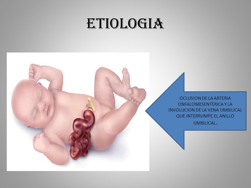 ETIOLOGIA OCLUSION DE LA ARTERIA ONFALOMESENTERICA Y LA INVOLUCION DE LA VENA UMBILICAL QUE INTERRUMPE EL ANILLO UMBILICAL.