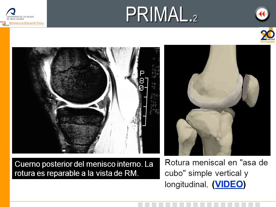 PRIMAL.2 Rotura meniscal en asa de cubo simple vertical y longitudinal. (VIDEO)