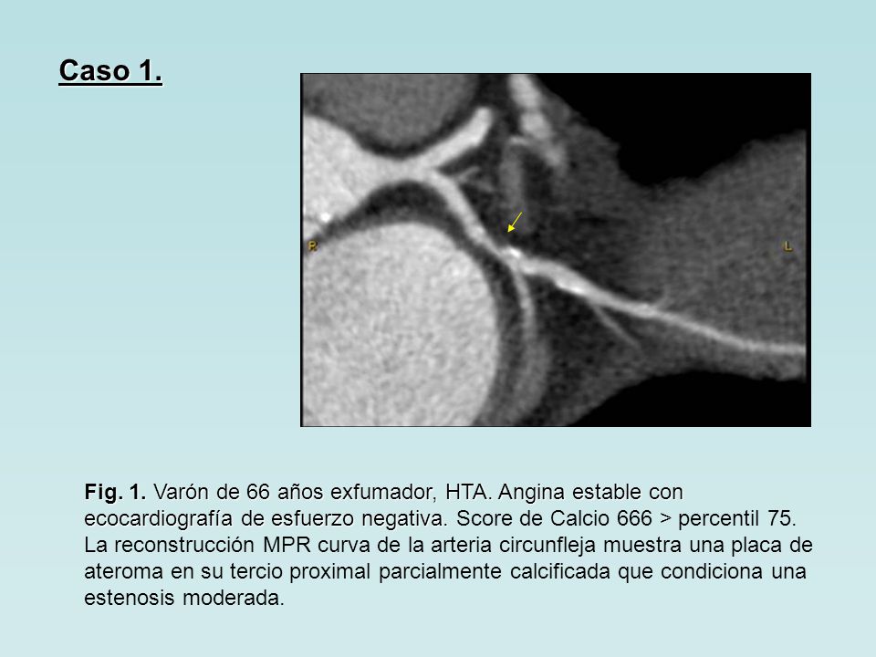 Caso 1. Fig. 1. Varón de 66 años exfumador, HTA. Angina estable con ecocardiografía de esfuerzo negativa. Score de Calcio 666 > percentil 75.