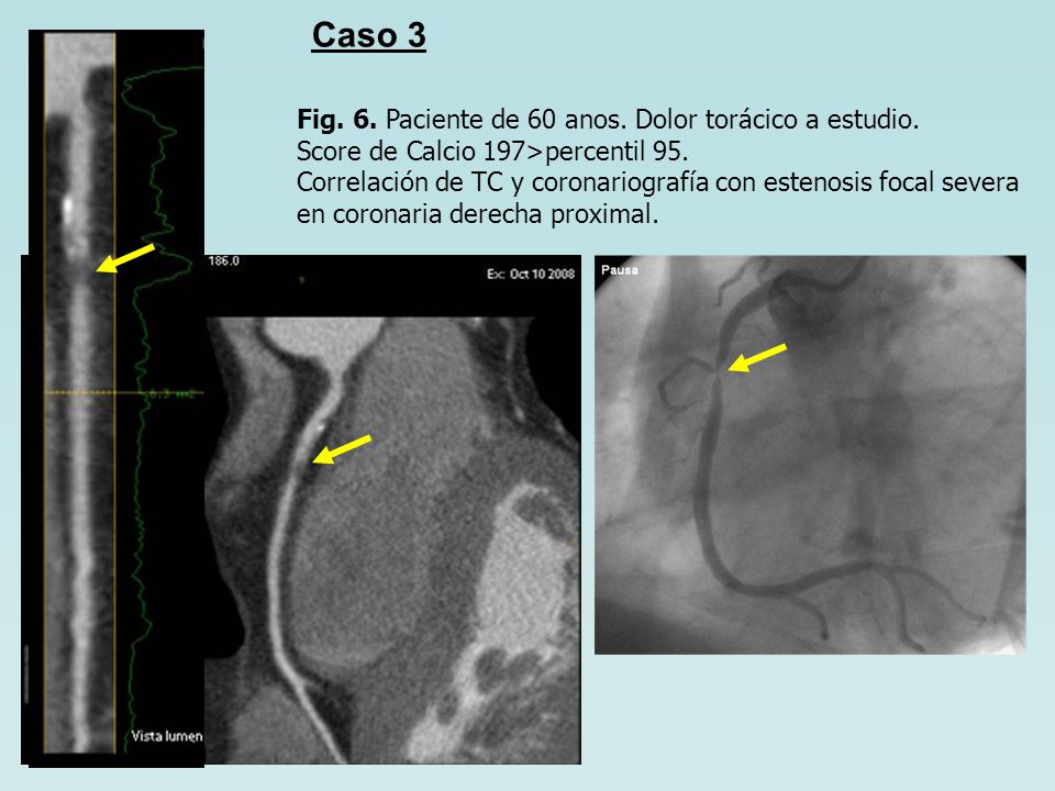 Caso 3 Fig. 6. Paciente de 60 anos. Dolor torácico a estudio.