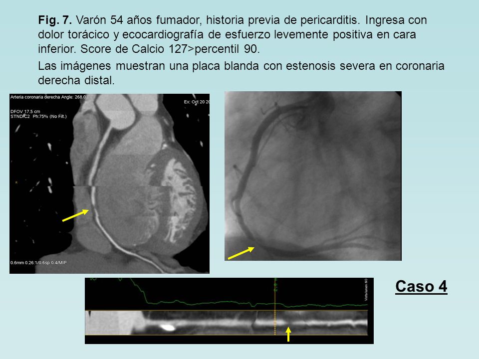 Fig. 7. Varón 54 años fumador, historia previa de pericarditis