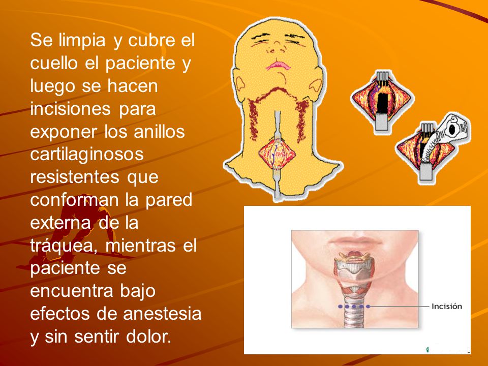 Se limpia y cubre el cuello el paciente y luego se hacen incisiones para exponer los anillos cartilaginosos resistentes que conforman la pared externa de la tráquea, mientras el paciente se encuentra bajo efectos de anestesia y sin sentir dolor.