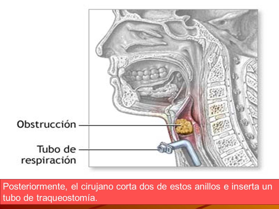 Posteriormente, el cirujano corta dos de estos anillos e inserta un tubo de traqueostomía.