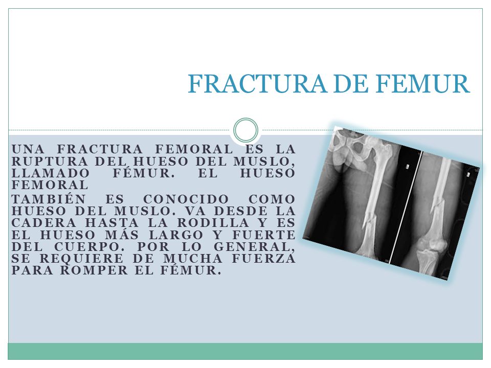 FRACTURA DE FEMUR Una fractura femoral es la ruptura del hueso del muslo, llamado fémur. El hueso femoral.