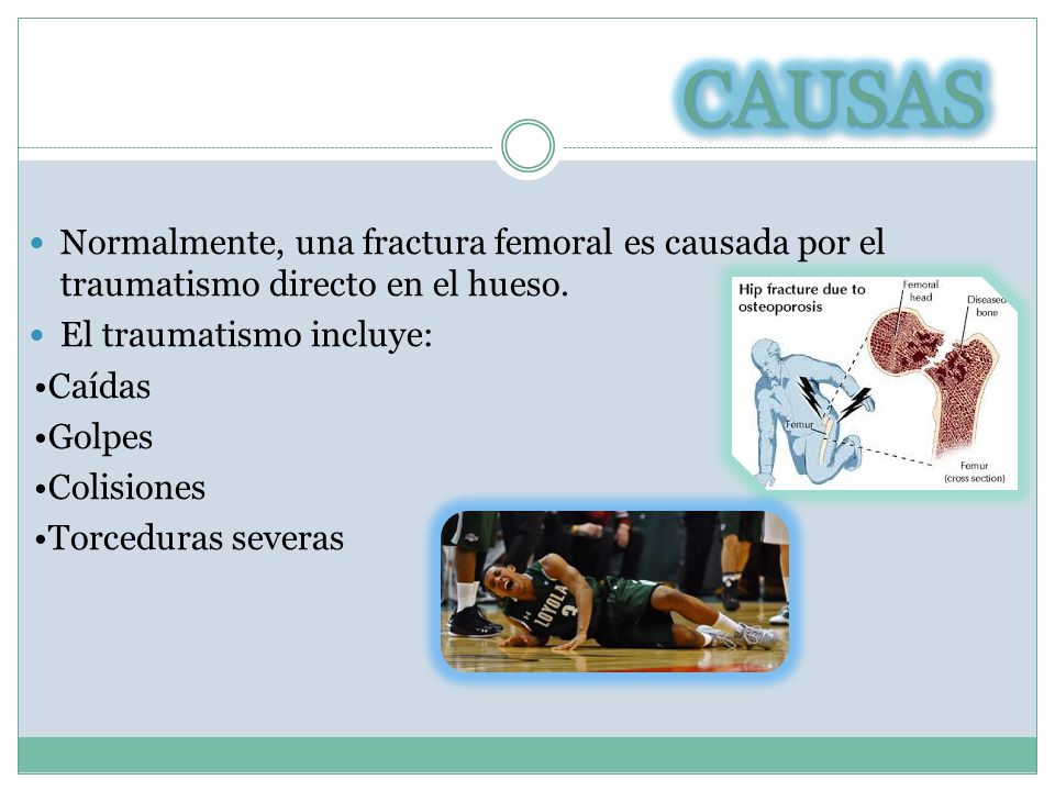 CAUSAS Normalmente, una fractura femoral es causada por el traumatismo directo en el hueso. El traumatismo incluye: