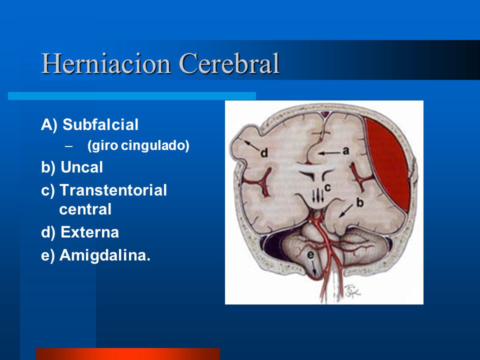 Herniacion Cerebral A) Subfalcial b) Uncal c) Transtentorial central