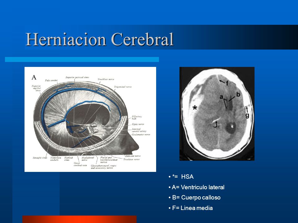 Herniacion Cerebral *= HSA A= Ventriculo lateral B= Cuerpo calloso