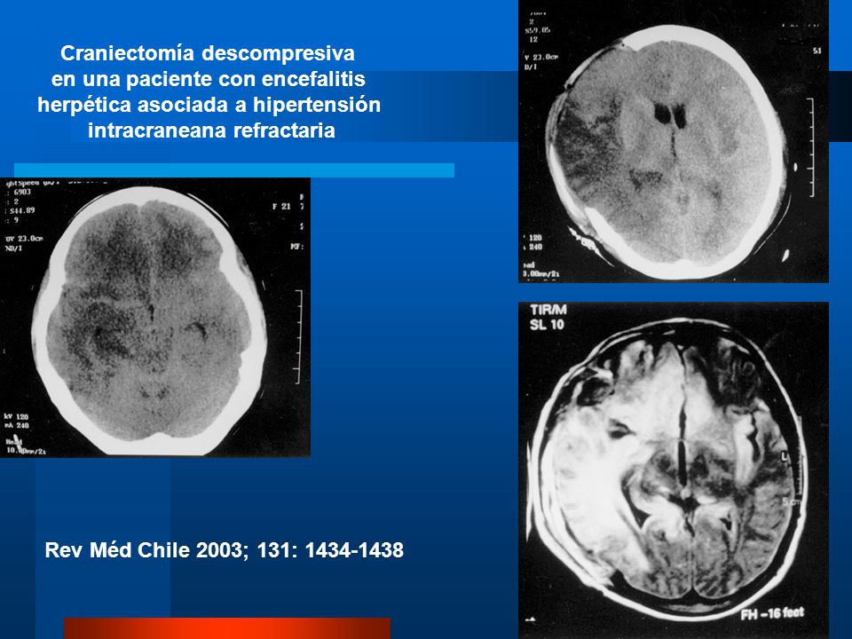 Craniectomía descompresiva en una paciente con encefalitis herpética asociada a hipertensión intracraneana refractaria