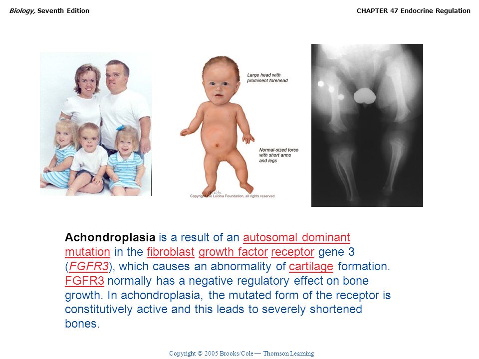 Achondroplasia is a result of an autosomal dominant mutation in the fibroblast growth factor receptor gene 3 (FGFR3), which causes an abnormality of cartilage formation.