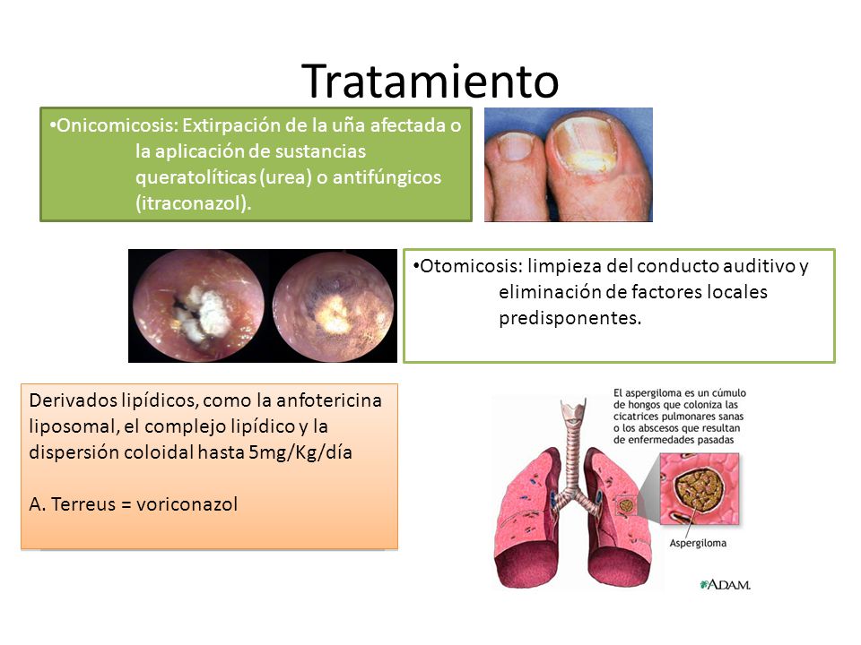 Tratamiento Onicomicosis: Extirpación de la uña afectada o la aplicación de sustancias queratolíticas (urea) o antifúngicos (itraconazol).