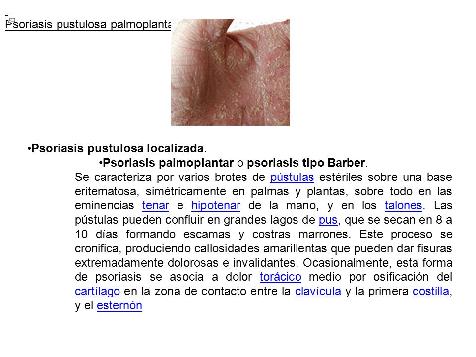 Psoriasis pustulosa palmoplantar. Psoriasis pustulosa localizada. Psoriasis palmoplantar o psoriasis tipo Barber.