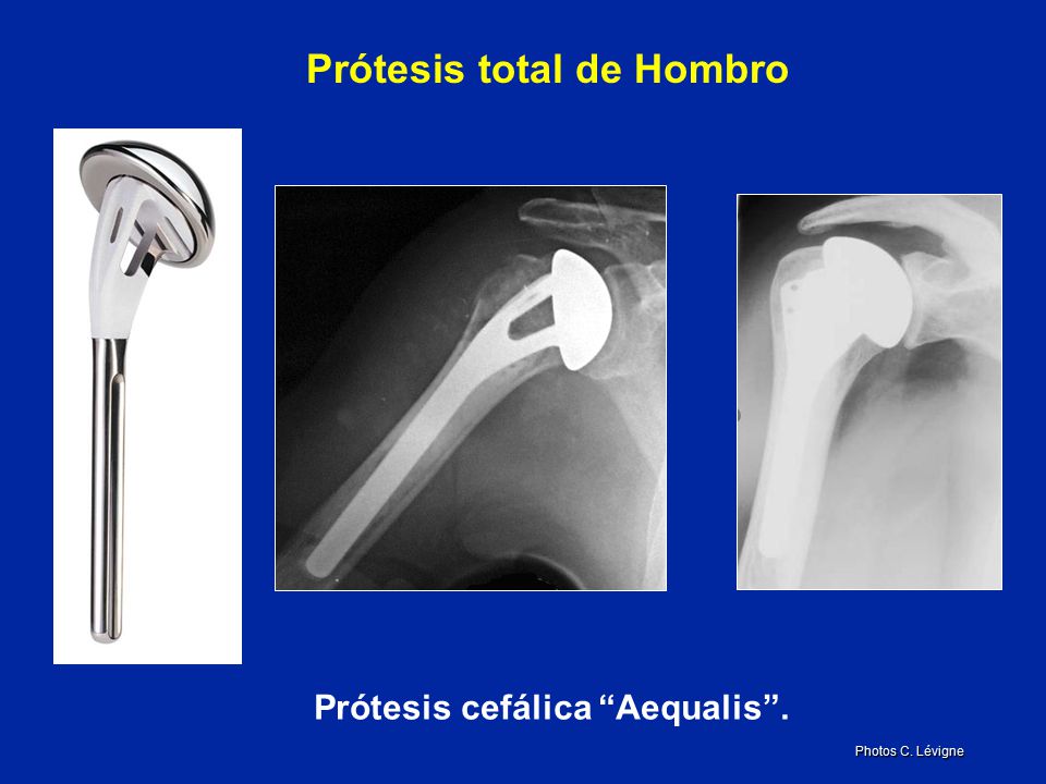 Prótesis total de Hombro Prótesis cefálica Aequalis .