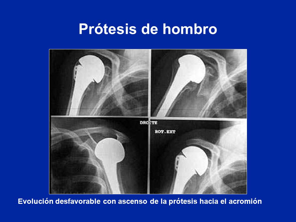 Prótesis de hombro Evolución desfavorable con ascenso de la prótesis hacia el acromión