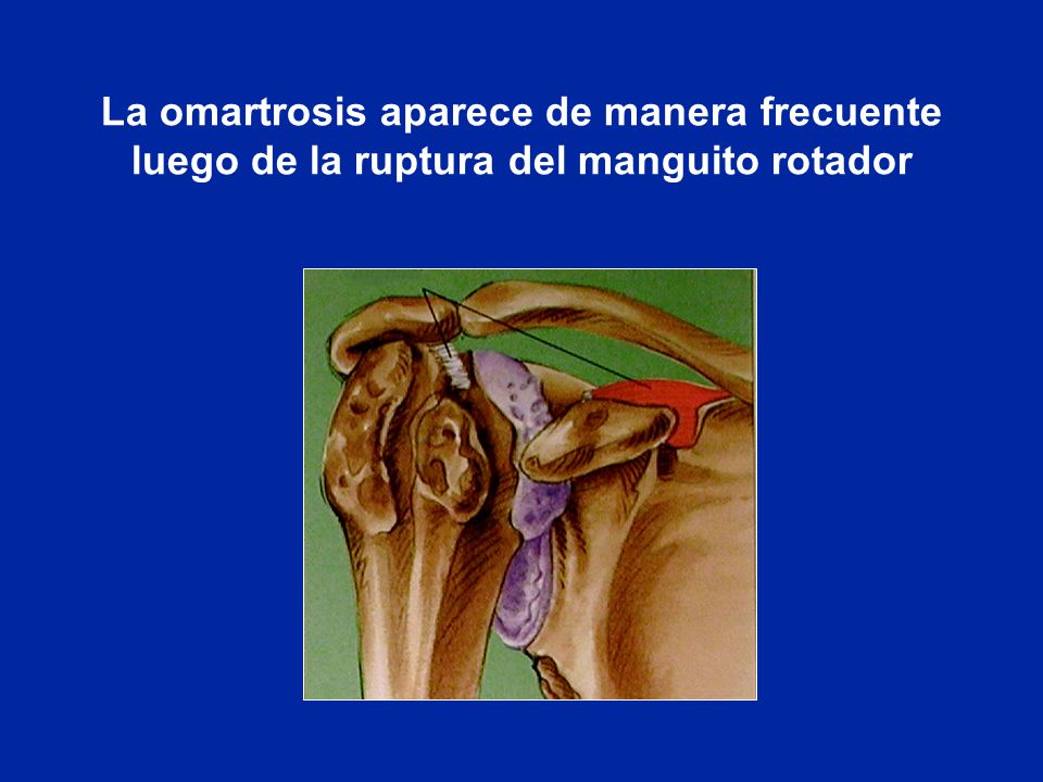 La omartrosis aparece de manera frecuente luego de la ruptura del manguito rotador
