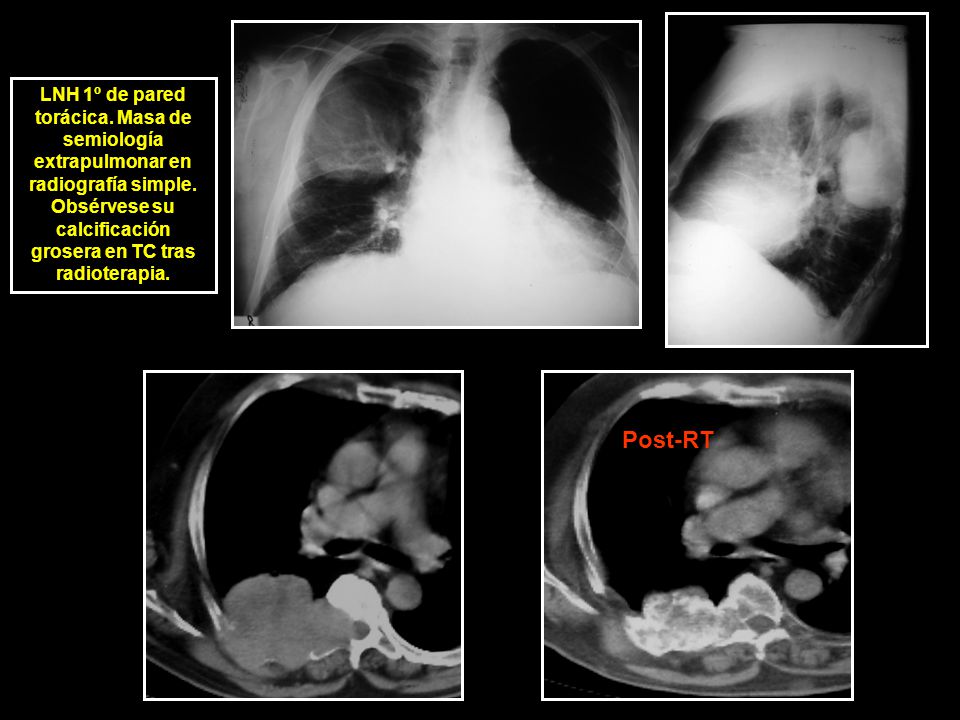 LNH 1º de pared torácica. Masa de semiología extrapulmonar en radiografía simple. Obsérvese su calcificación grosera en TC tras radioterapia.