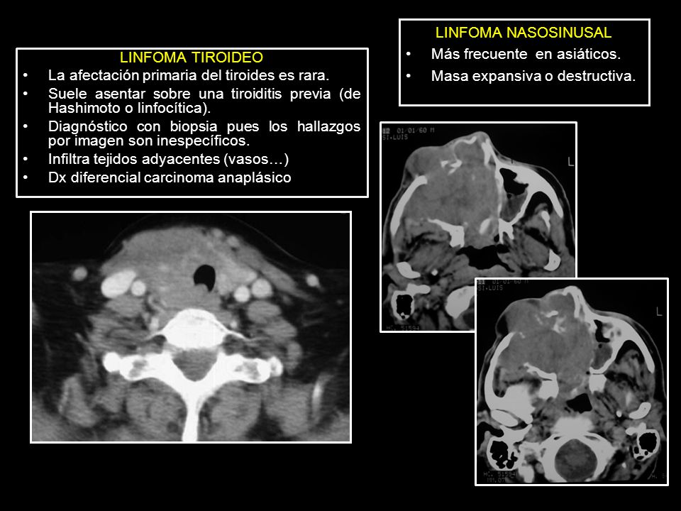 LINFOMA NASOSINUSAL Más frecuente en asiáticos. Masa expansiva o destructiva. LINFOMA TIROIDEO. La afectación primaria del tiroides es rara.