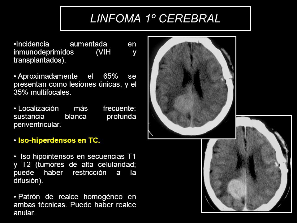 LINFOMA 1º CEREBRAL Incidencia aumentada en inmunodeprimidos (VIH y transplantados).