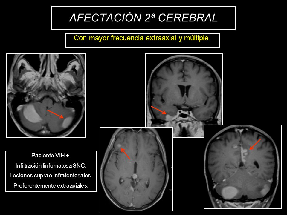 AFECTACIÓN 2ª CEREBRAL Con mayor frecuencia extraaxial y múltiple.