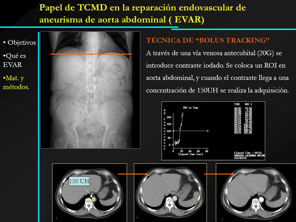 Papel de TCMD en la reparación endovascular de aneurisma de aorta abdominal ( EVAR)