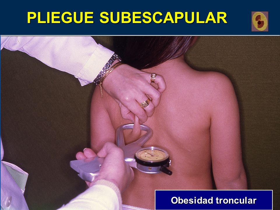 PLIEGUE SUBESCAPULAR Obesidad troncular