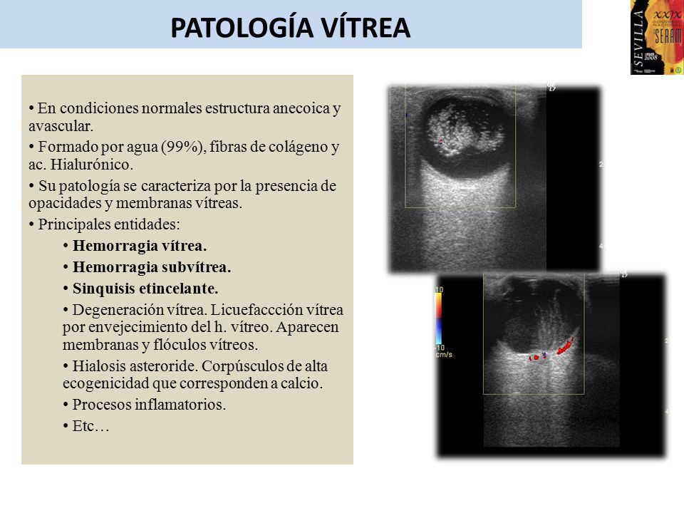 PATOLOGÍA VÍTREA En condiciones normales estructura anecoica y avascular. Formado por agua (99%), fibras de colágeno y ac. Hialurónico.