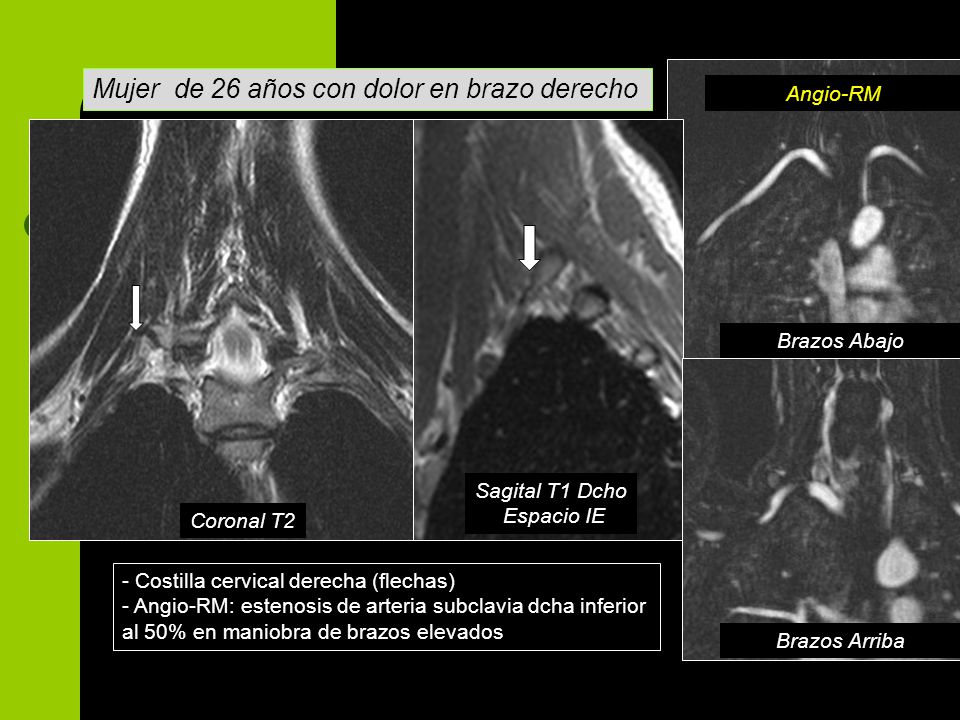 Mujer de 26 años con dolor en brazo derecho
