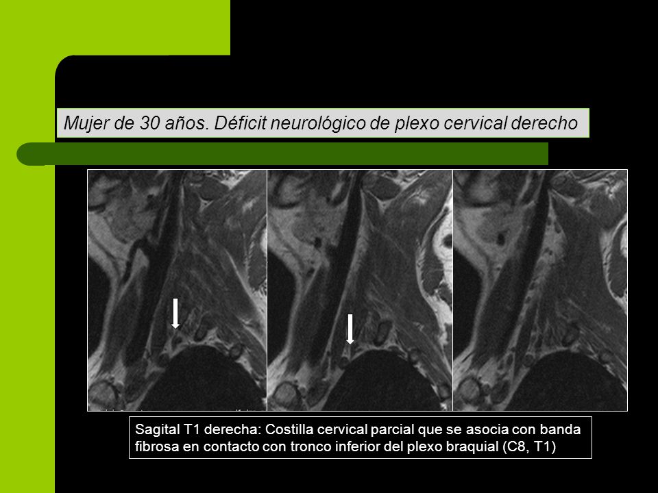 Mujer de 30 años. Déficit neurológico de plexo cervical derecho