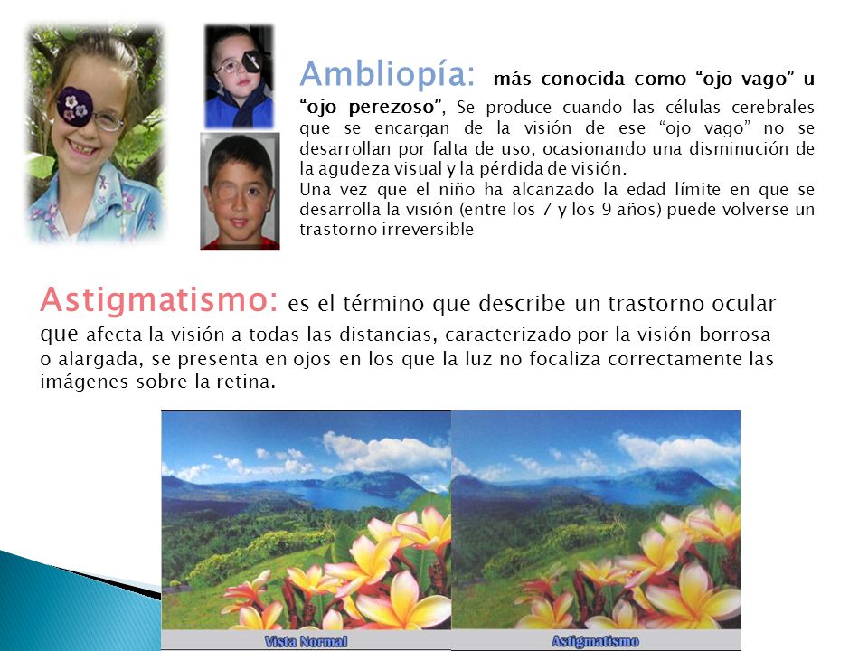 Ambliopía: más conocida como ojo vago u ojo perezoso , Se produce cuando las células cerebrales que se encargan de la visión de ese ojo vago no se desarrollan por falta de uso, ocasionando una disminución de la agudeza visual y la pérdida de visión.