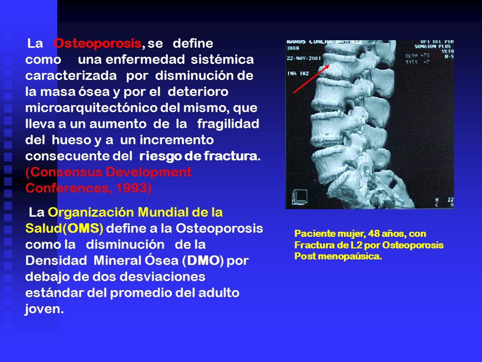 La Osteoporosis, se define como una enfermedad sistémica caracterizada por disminución de la masa ósea y por el deterioro microarquitectónico del mismo, que lleva a un aumento de la fragilidad del hueso y a un incremento consecuente del riesgo de fractura. (Consensus Development Conferences, 1993)