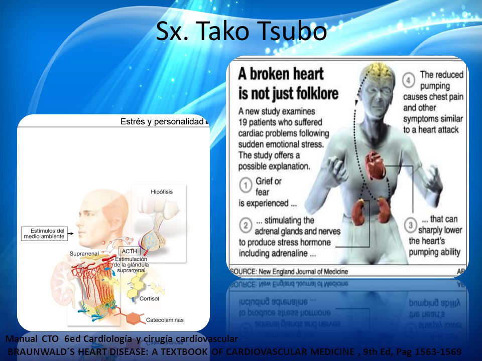 Sx. Tako Tsubo Manual CTO 6ed Cardiología y cirugía cardiovascular