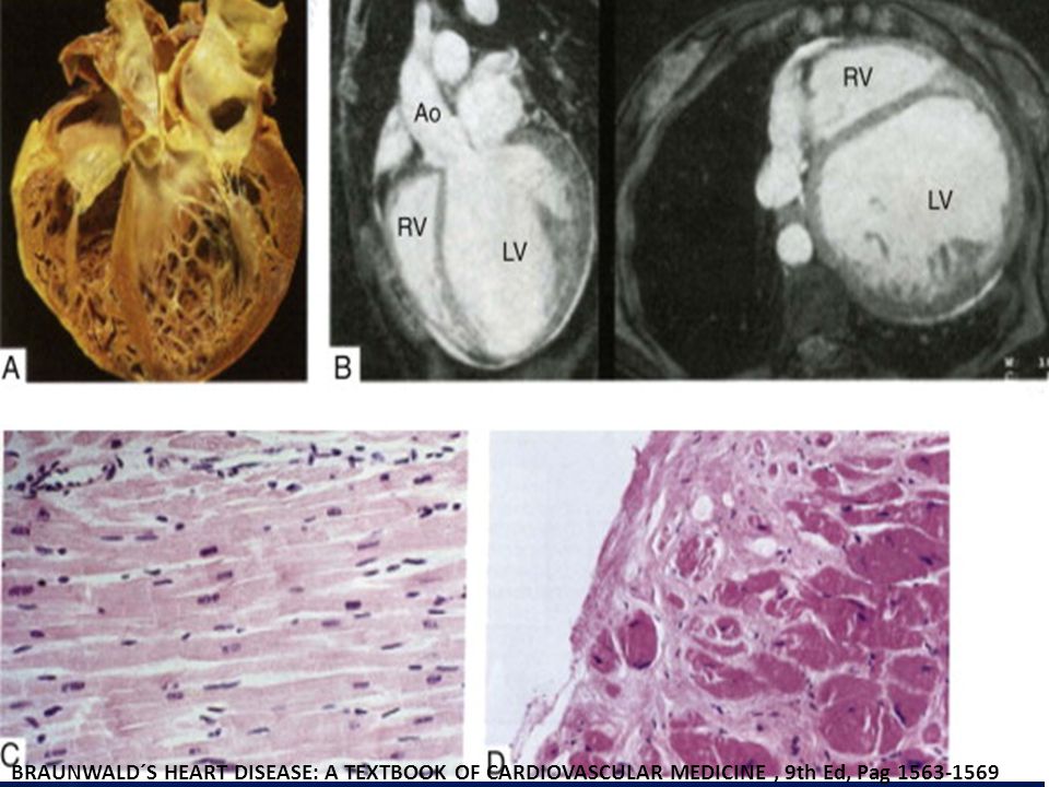 fibrosis con necrosis infiltración celular. trombos en paredes de cavidades dilatadas.