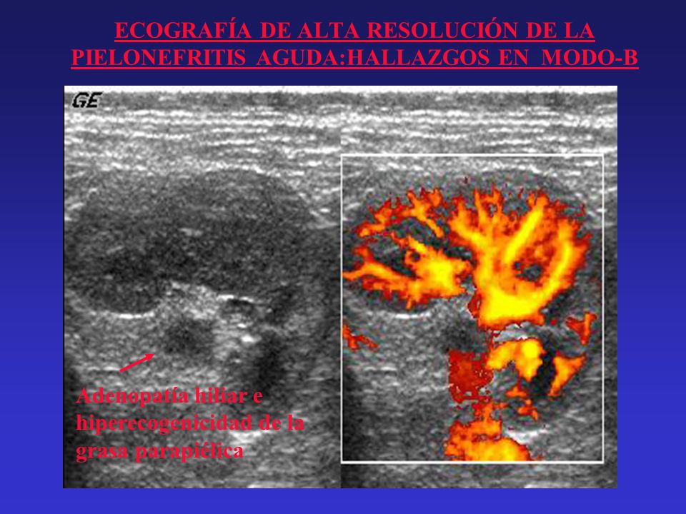 ECOGRAFÍA DE ALTA RESOLUCIÓN DE LA PIELONEFRITIS AGUDA:HALLAZGOS EN MODO-B