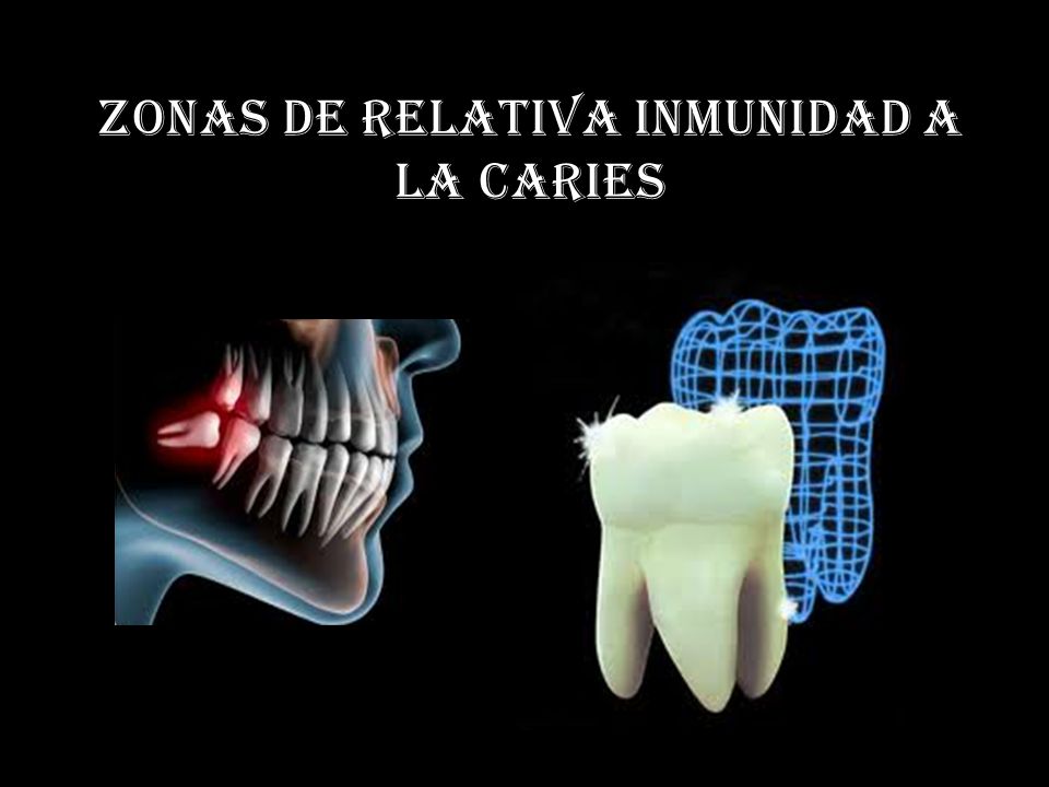 Zonas de relativa inmunidad a la caries