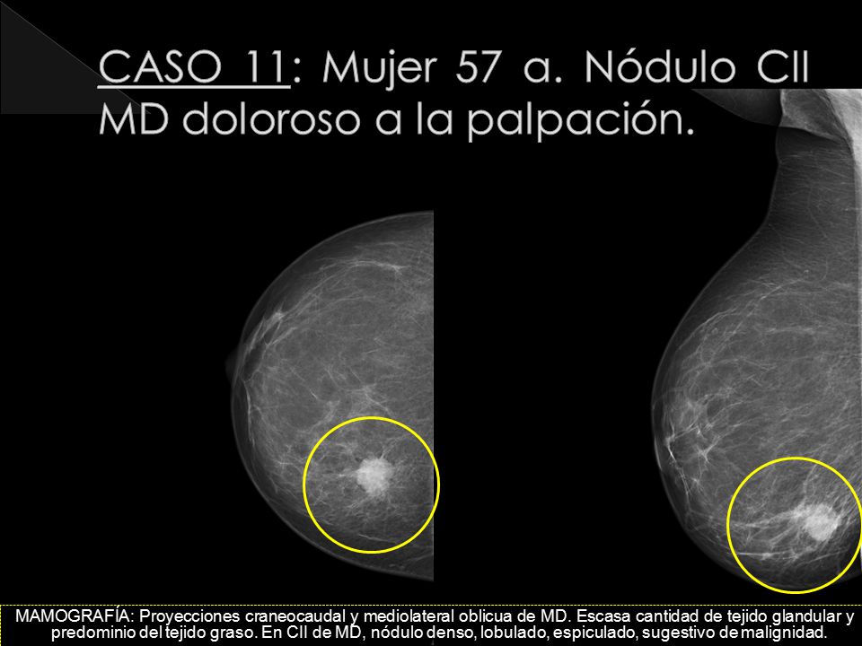 CASO 11: Mujer 57 a. Nódulo CII MD doloroso a la palpación.